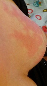 A red swollen breast with mastitis