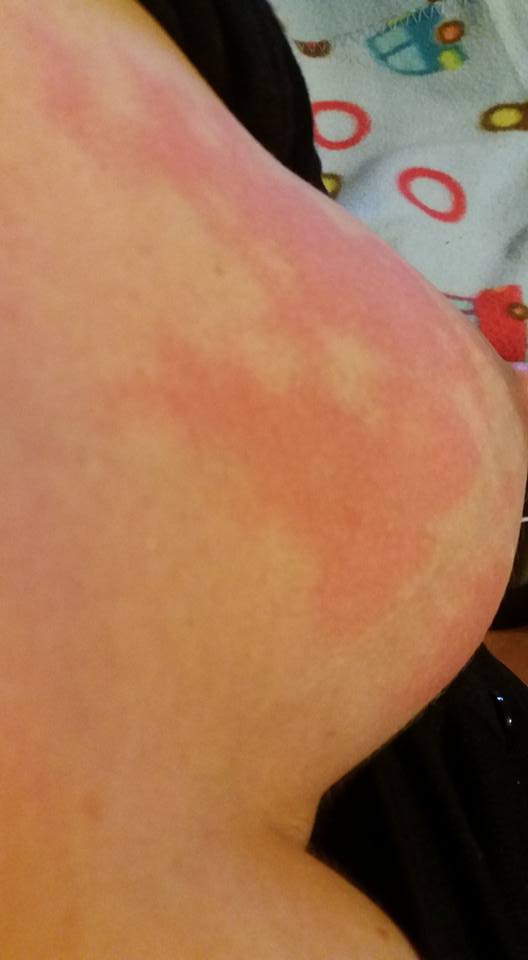 Breastfeeding Ziggy: Mastitis is a Motherfucker.
